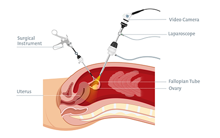 laparoscopy-for-endometriosis-diagram.png